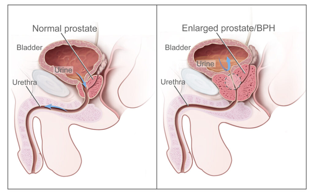 BENIGN PROSTATIC HYPERPLASIA (BPH)