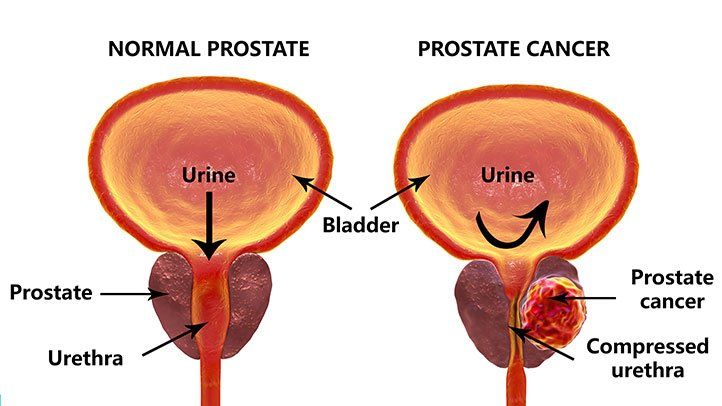 Prostate Cancer